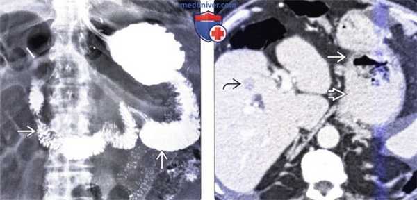 Рентгенография, КТ при резекции желудка по Бильрот