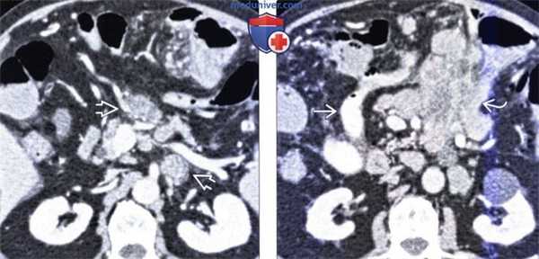 Рентгенография, КТ при резекции желудка по Бильрот