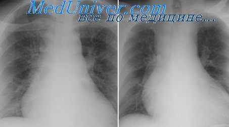 томография средостения