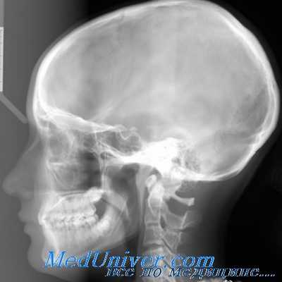 рентгенография височной кости