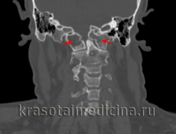 КТ шейного отдела позвоночника. Сращение атланта с затылочной костью.