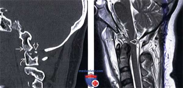 КТ, МРТ атланто-затылочной дислокации