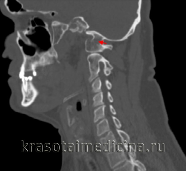 Ассимиляция атланта