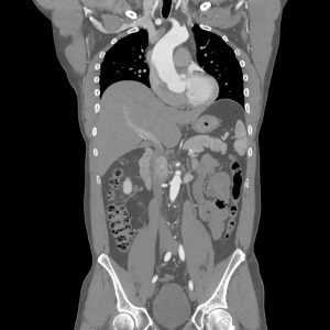 Компьютерная томография (КТ) забрюшинного пространства