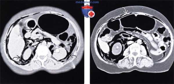 Лучевые изменения брюшной полости при баротравме