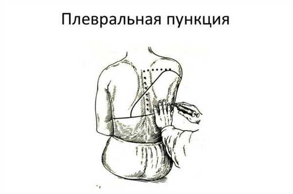 Пункция плевральной полости