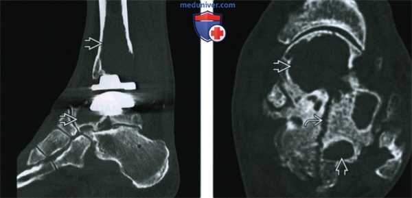 Эндопротез голеностопного сустава - лучевая оценка