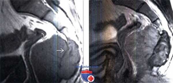 МРТ гигантоклеточной опухоли позвоночника