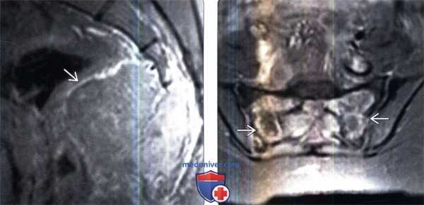 МРТ гигантоклеточной опухоли позвоночника