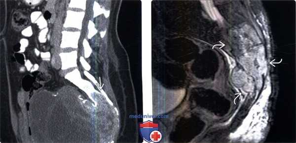 МРТ, КТ гигантоклеточной опухоли позвоночника