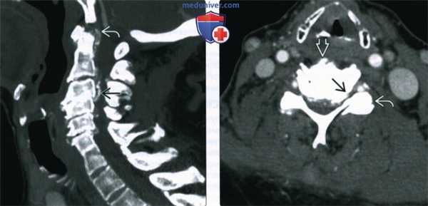 Рентгенограмма, КТ, МРТ при остеоартрозе осевого скелета