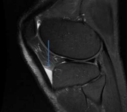 Воспаление глубокой поднадколенниковой сумки на МР-скане