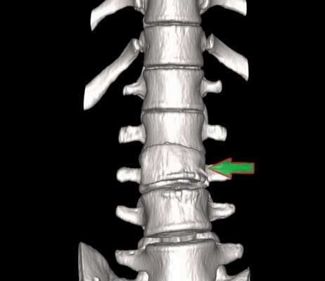 Как следует готовиться к компьютерной томографии позвоночника