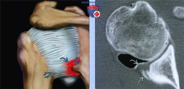 Признаки повреждения Беннетта
