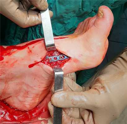 артродез сустава лисфранка