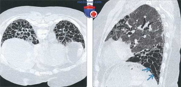 КТ изменения легких при системном склерозе (склеродермии)