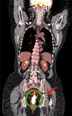 Результаты ПЭТ/КТ-исследования 18F-FDG. Метаболически активная специфическая ткань в прямой кишке.