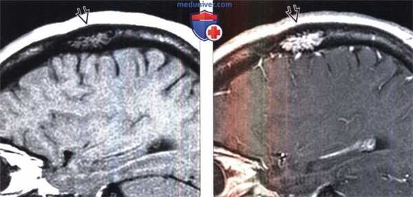 Гемангиома свода черепа на МРТ