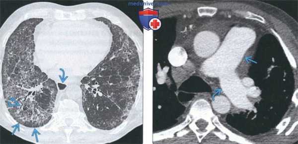 КТ изменения легких при системном склерозе (склеродермии)