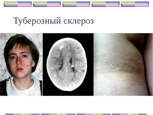 Туберозный склероз у детей