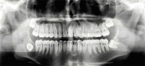 Рис. 1. Рентгенограмма до операции: очаг остеолиза в области угла нижней челюсти справа, многокамерный, с относительно четкими границами. Ретенированный дистопированный 48 зуб мудрости.