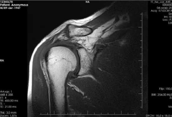 МРТ плечевого сустава что показывает