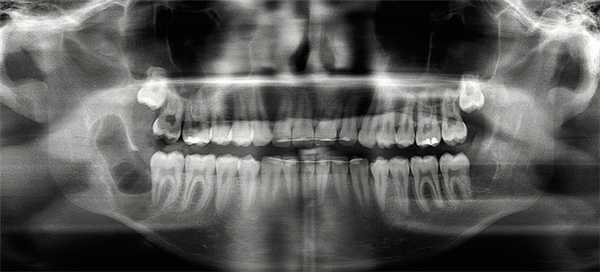 Рис. 2. Послеоперационная контрольная рентгенограмма: состояние после оперативного удаления 48 зуба мудрости, энуклеации тканей кисты в области 48 зуба и кюретажа образовавшейся костной полости.