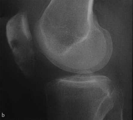 Снимки МРТ и КТ. Перелом надколенника