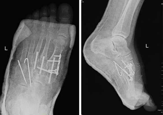 вывих в суставе лисфранка рентген