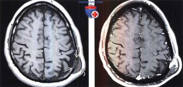 Гемангиома свода черепа на МРТ
