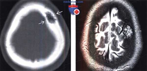 Гемангиома свода черепа на КТ, МРТ