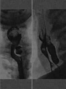 Снимки МРТ и КТ. Дивертикул Ценкера