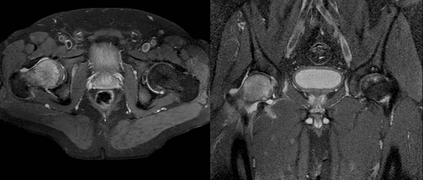 МРТ тазобедренного сустава