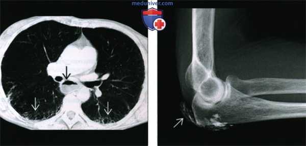 Рентгенограмма, КТ, МРТ при прогрессирующем системном склерозе