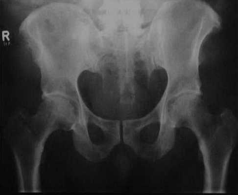 Снимки МРТ и КТ. Диффузный идиопатический гиперостоз скелета