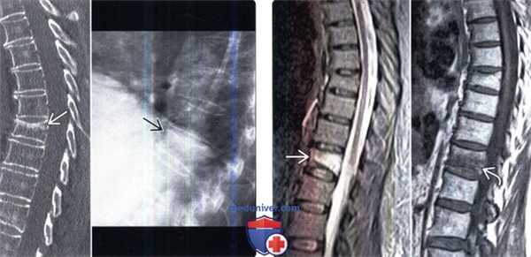 Рентгенограмма, КТ, МРТ при остеопорозе позвоночника