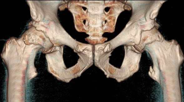 Трехмерная реконструкция тазобедренных сочленений
