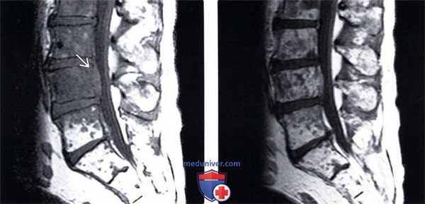 Рентгенограмма, КТ, МРТ литических костных метастазов позвоночника
