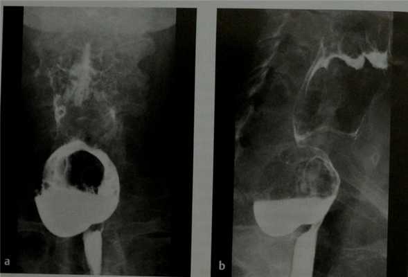 Снимки МРТ и КТ. Дивертикулы пищевода