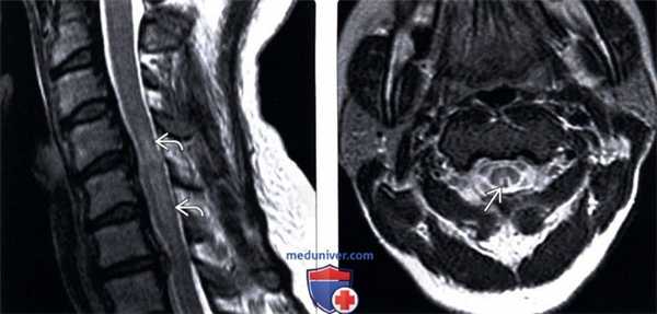 МРТ подострой комбинированной дегенерации