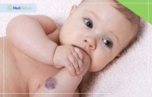 инфантильная гемангиома фото