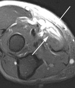 razryv-kruglogo-pronatora