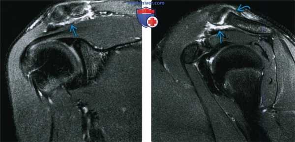 Рентгенограмма, КТ, МРТ при травме акромиально-ключичного сустава