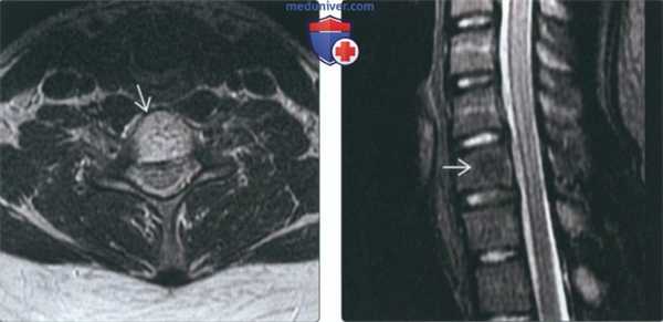 КТ, МРТ при гемангиоме шейных позвонков