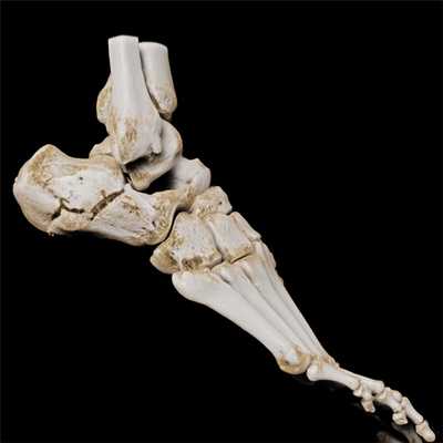 КТ стопы снимок