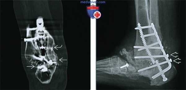 Артродез голеностопного сустава - лучевая оценка
