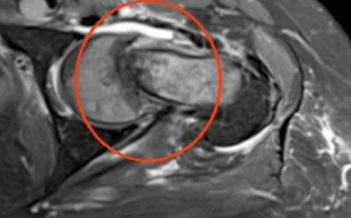 МРТ: метастаз в шейку бедра 