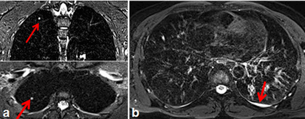 Туберкулез на снимке МРТ