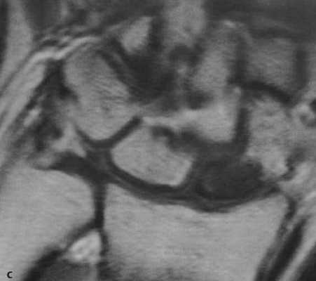 Снимки МРТ и КТ. Перелом ладьевидной кости
