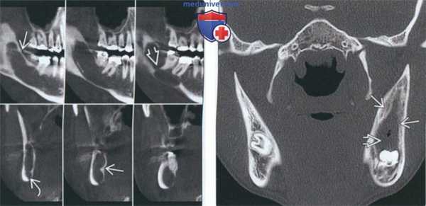 Рентгенограмма, КТ, МРТ при одонтогенной кератокисте